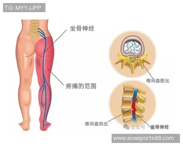 专家解读坐骨神经痛成因及治疗方法大多数患者可避免手术治疗